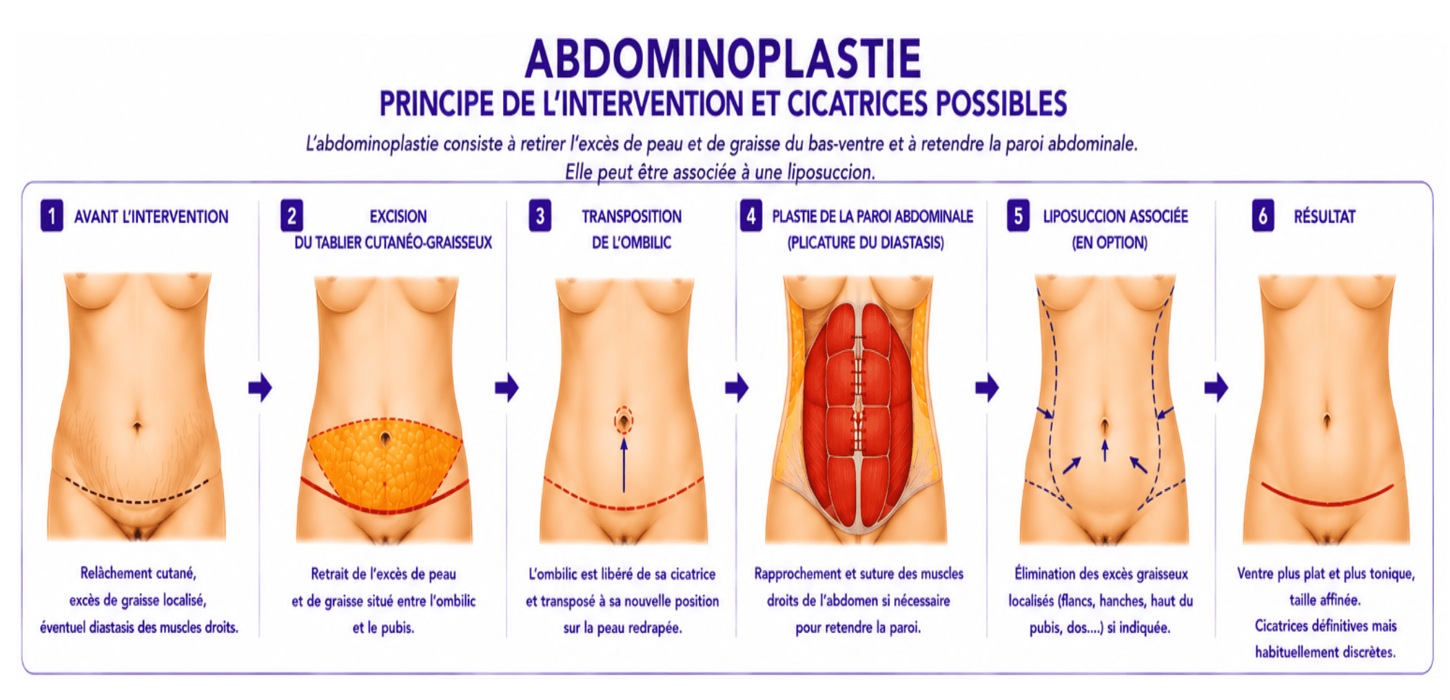 Voici une représentation visuelle et schématique de l'abdominoplastie.
