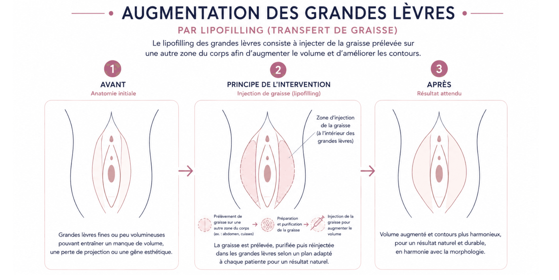 Here is a visual and schematic representation of the labia majora augmentation.
