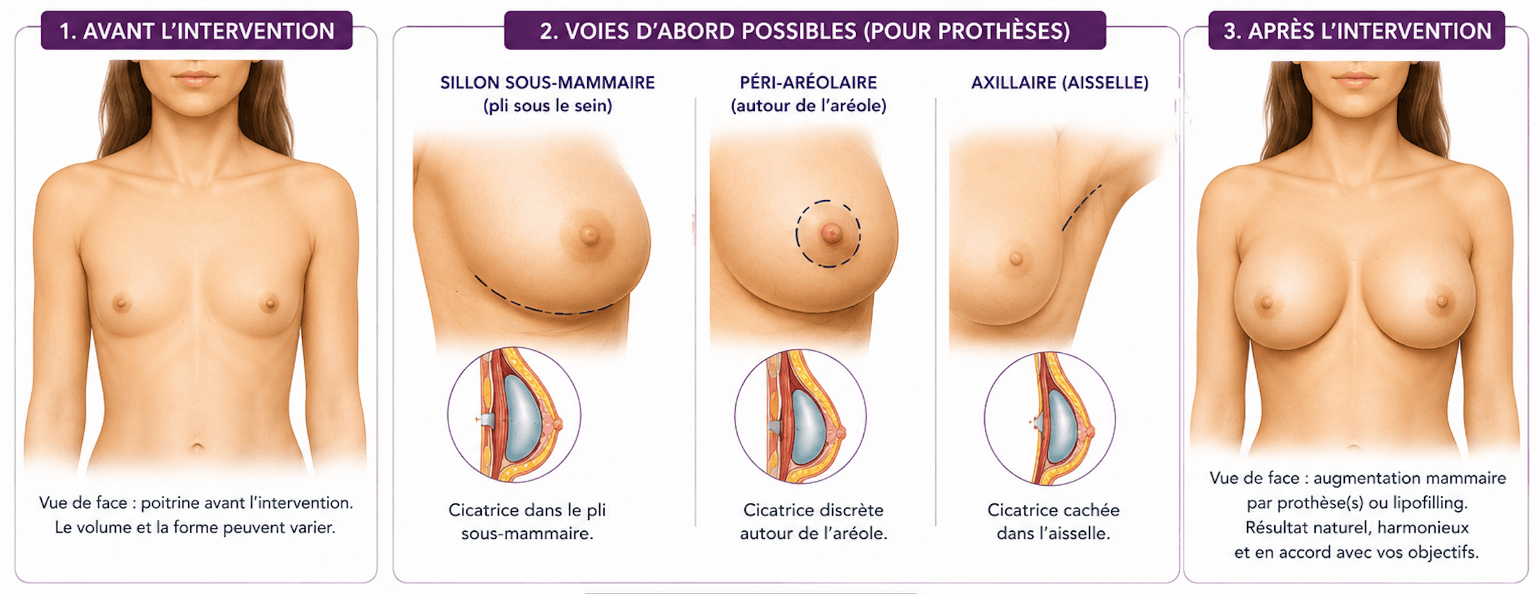 Voici une représentation visuelle et schématique de l'augmentation mammaire.