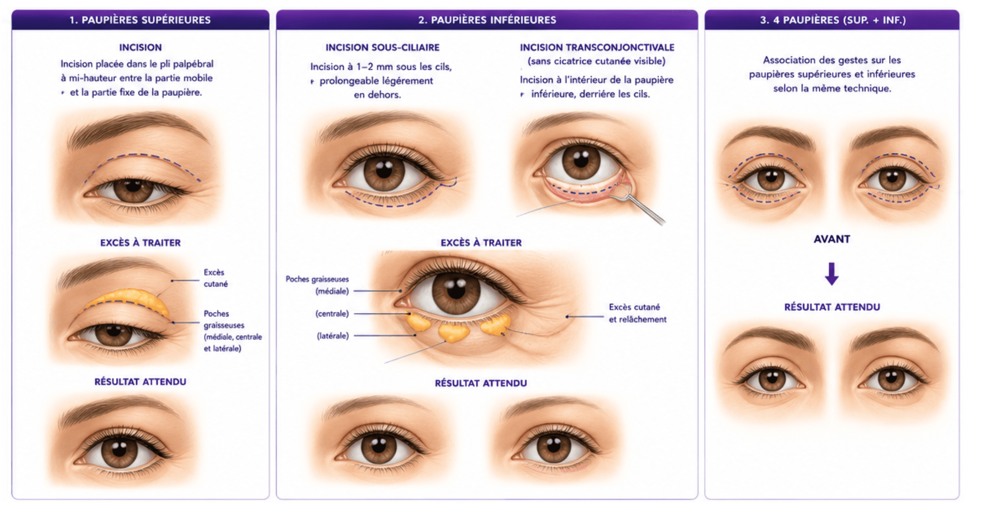 Here is a visual and schematic representation of the blepharoplasty.
