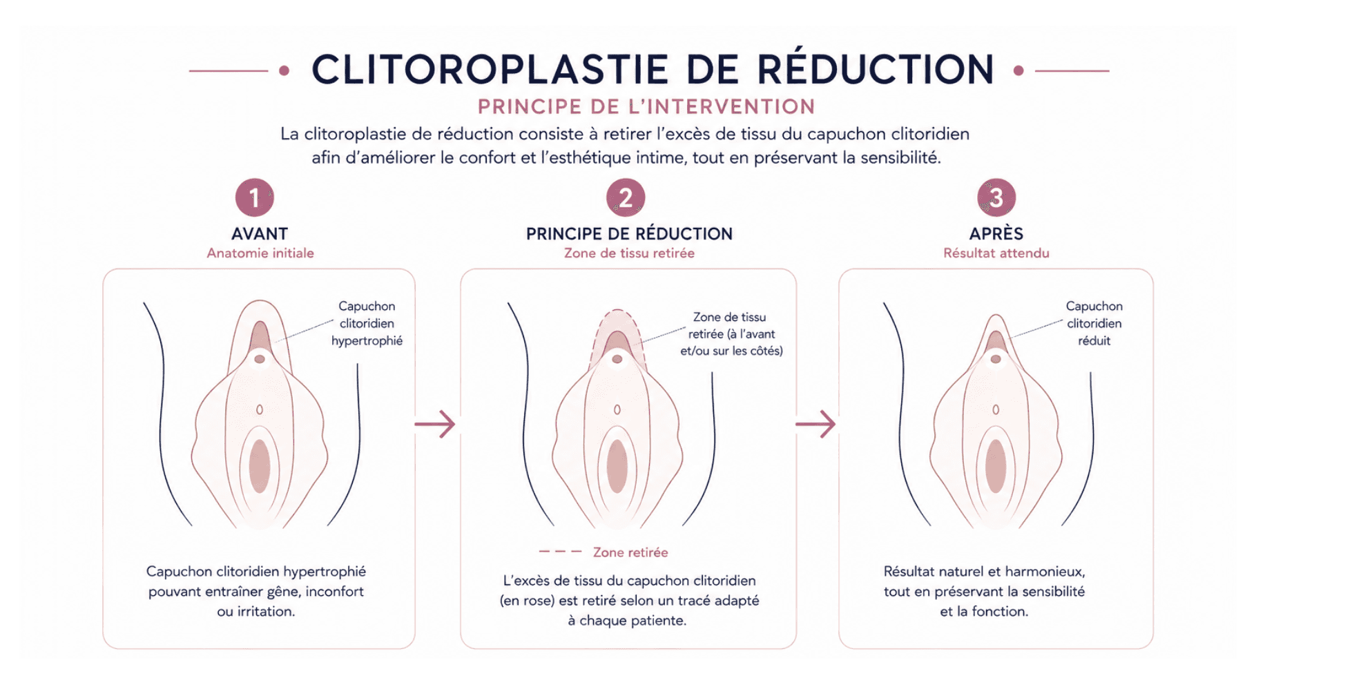 Here is a visual and schematic representation of the clitoroplasty.
