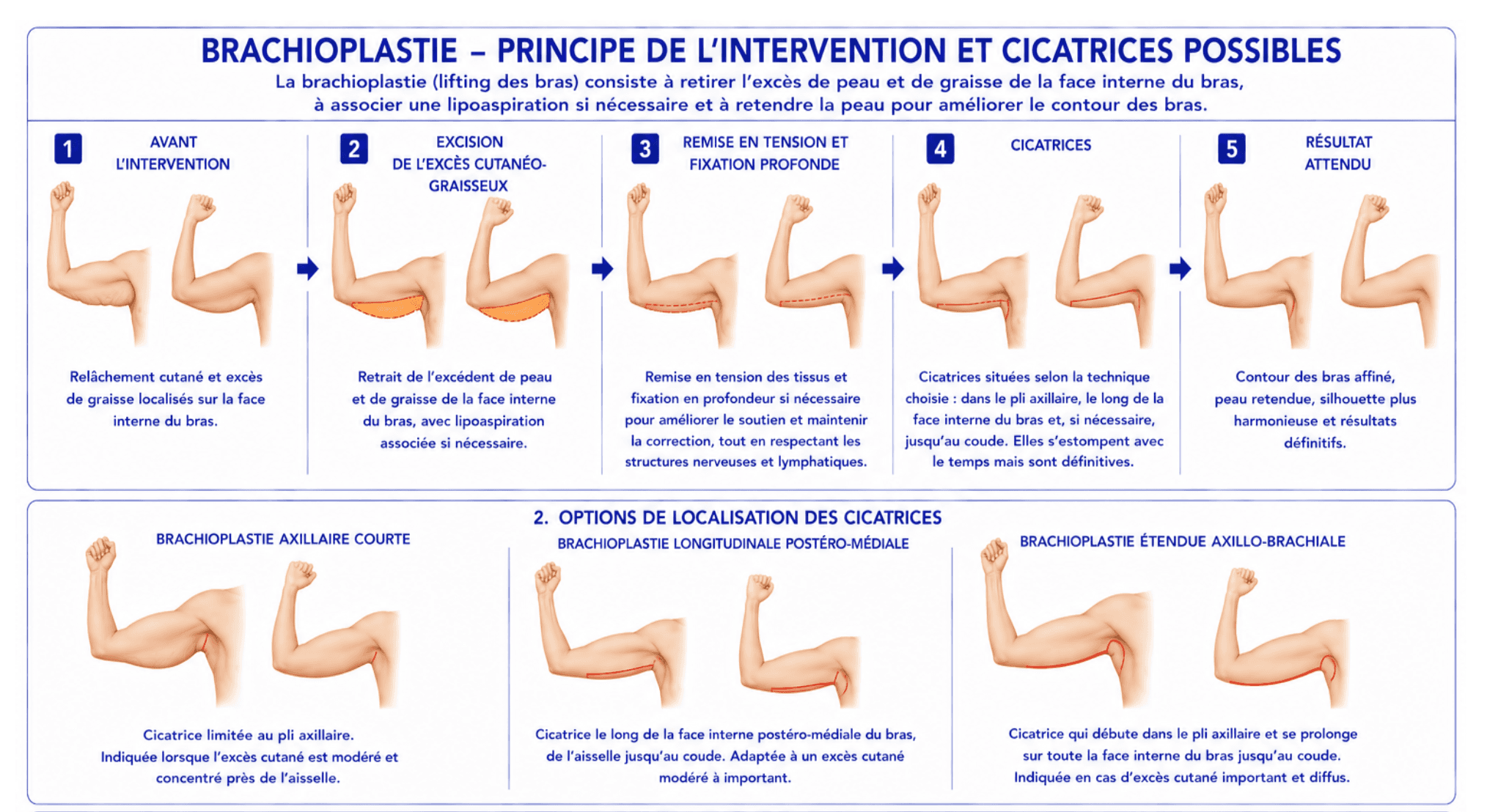 Here is a visual and schematic representation of the brachioplasty.