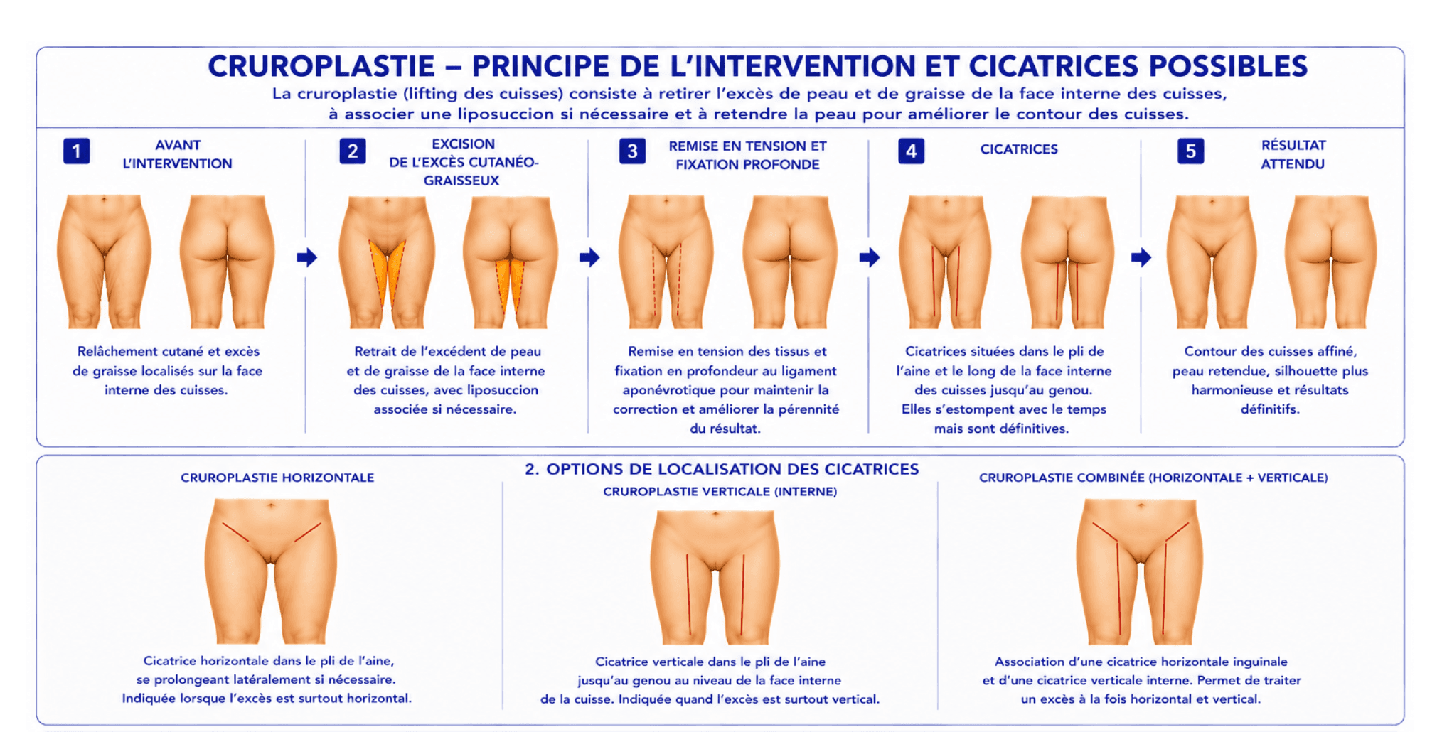 Aquí tiene una representación visual y esquemática del lifting de muslos.