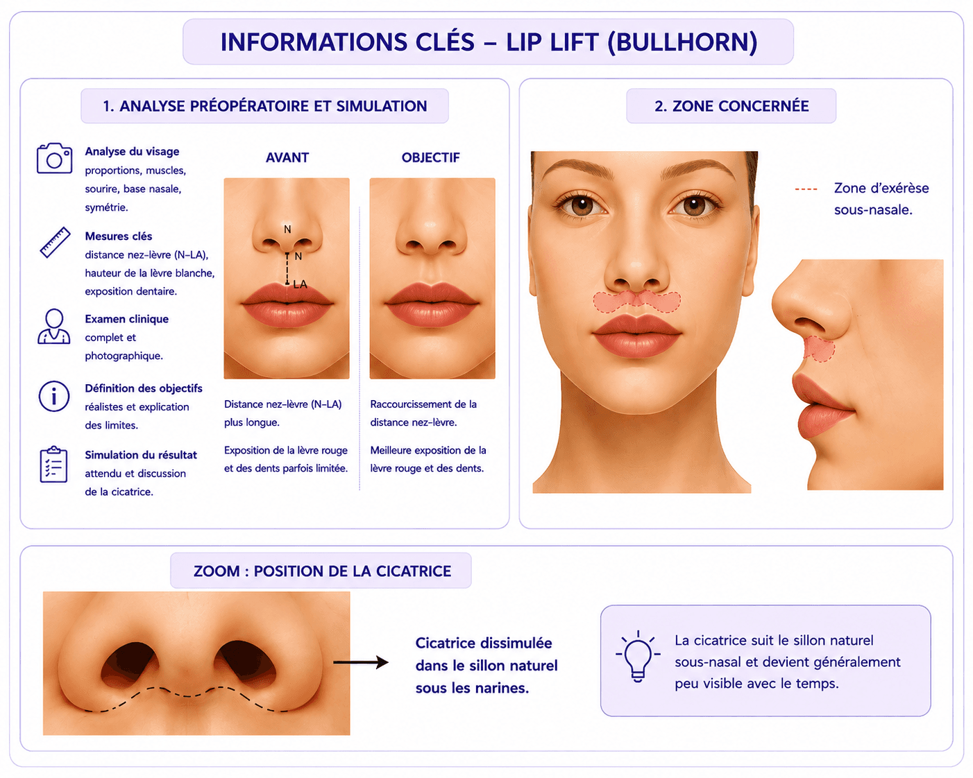 Voici une représentation visuelle et schématique du lip lift.
