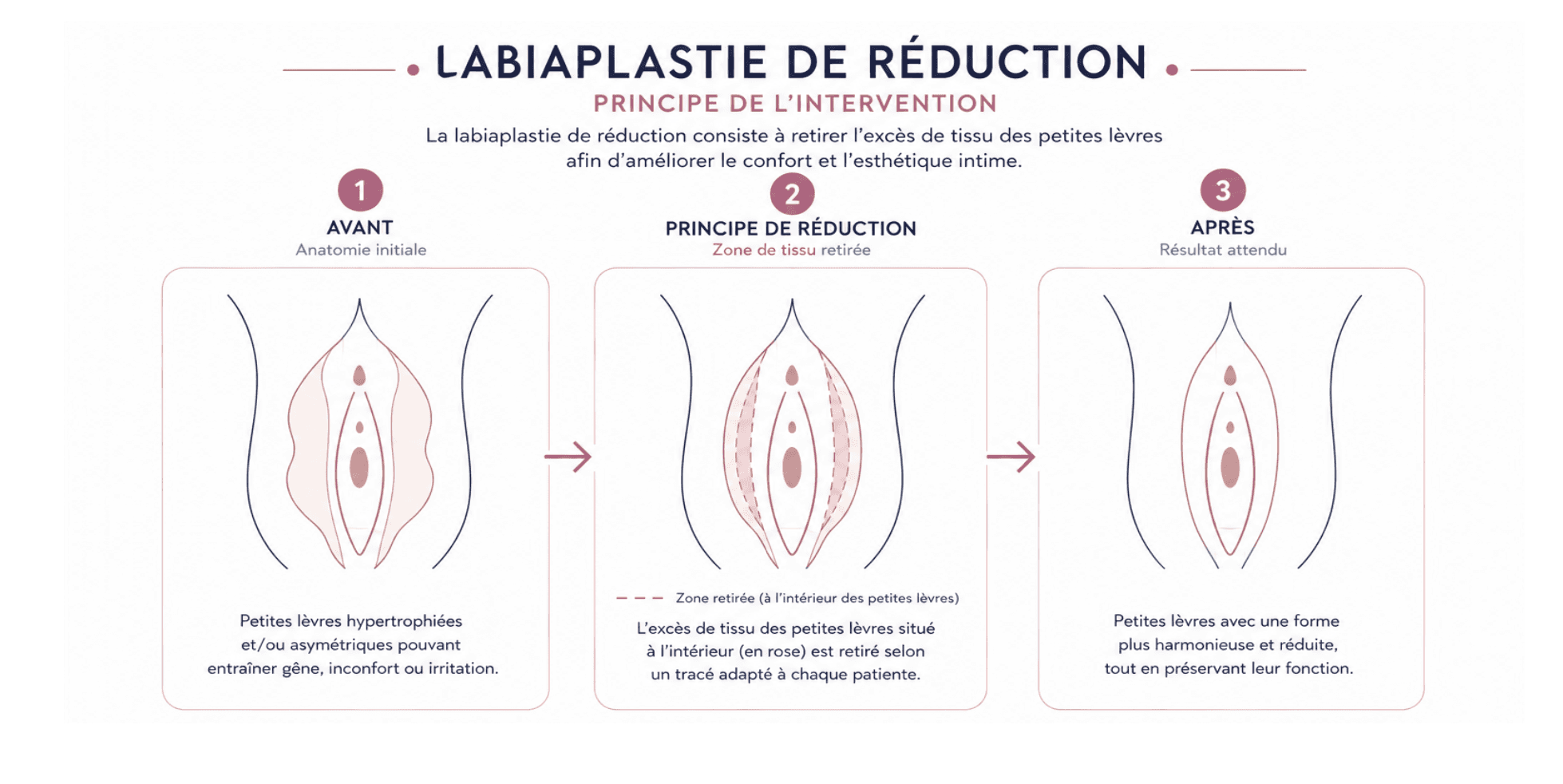 Voici une représentation visuelle et schématique de la labiaplastie.