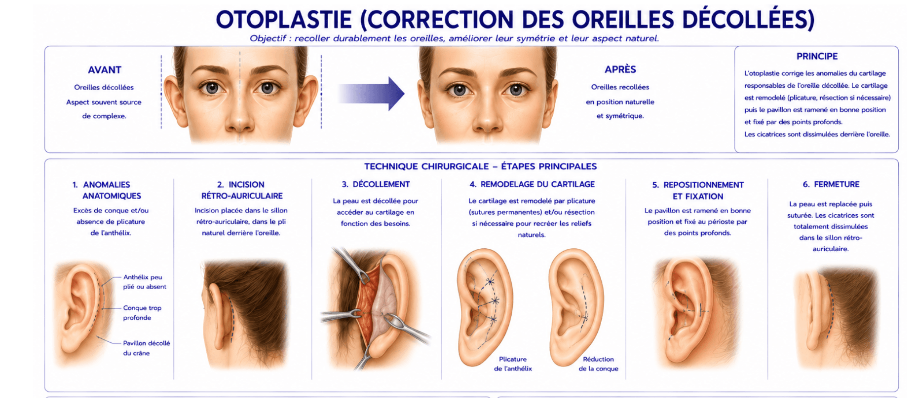 Here is a visual and schematic representation of the otoplasty.
