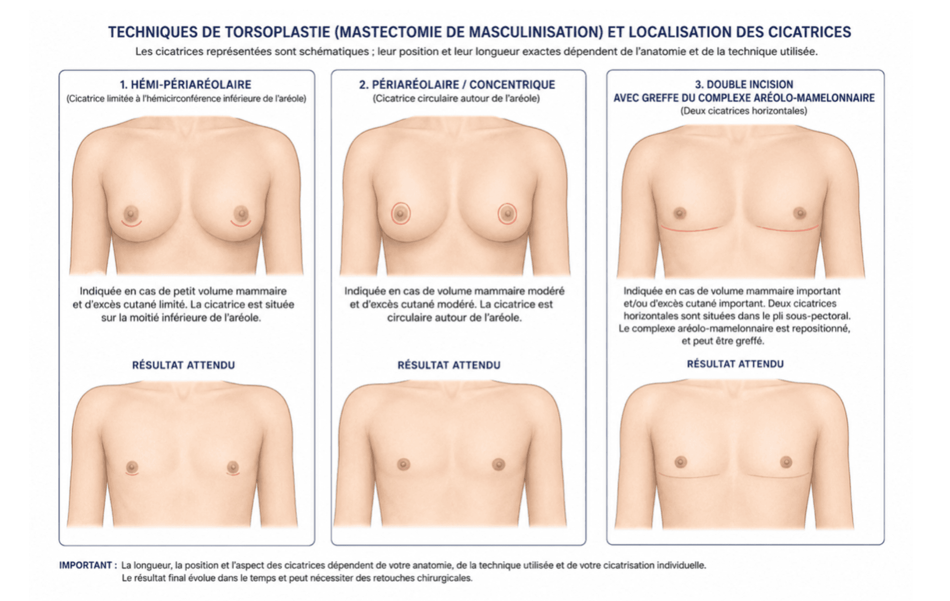 Voici une représentation visuelle et schématique de la torsoplastie.